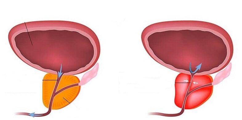 Zdravá a zanícená prostata prostatitidou