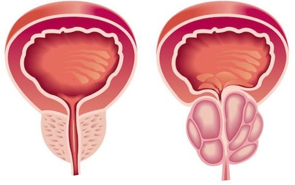 zdravá a zanícená prostata s prostatitidou